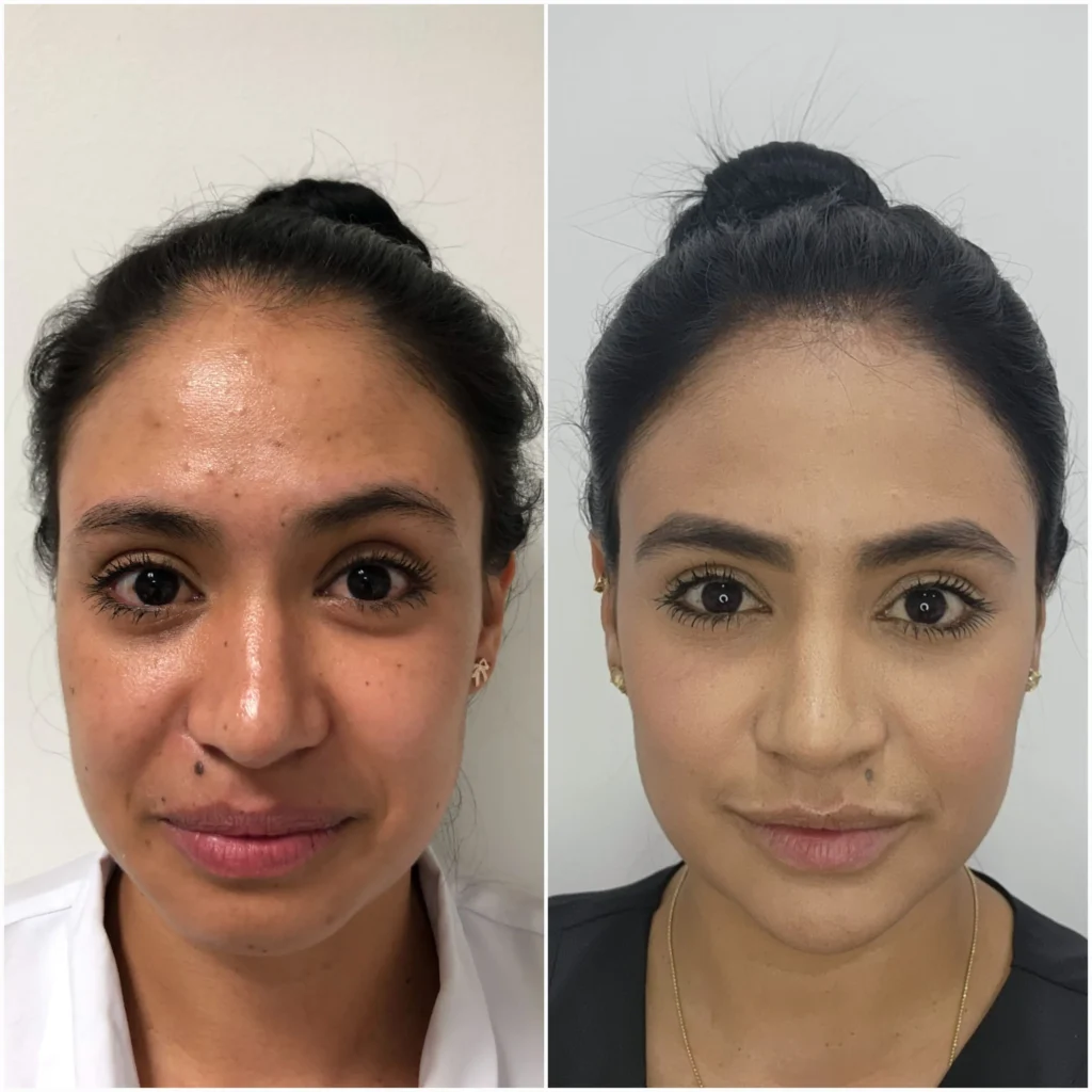 antes y despues lifting facial sin cirugia