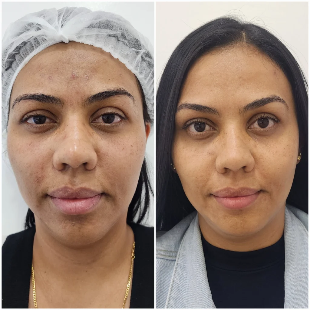 lifting facial sin cirugia antes y despues