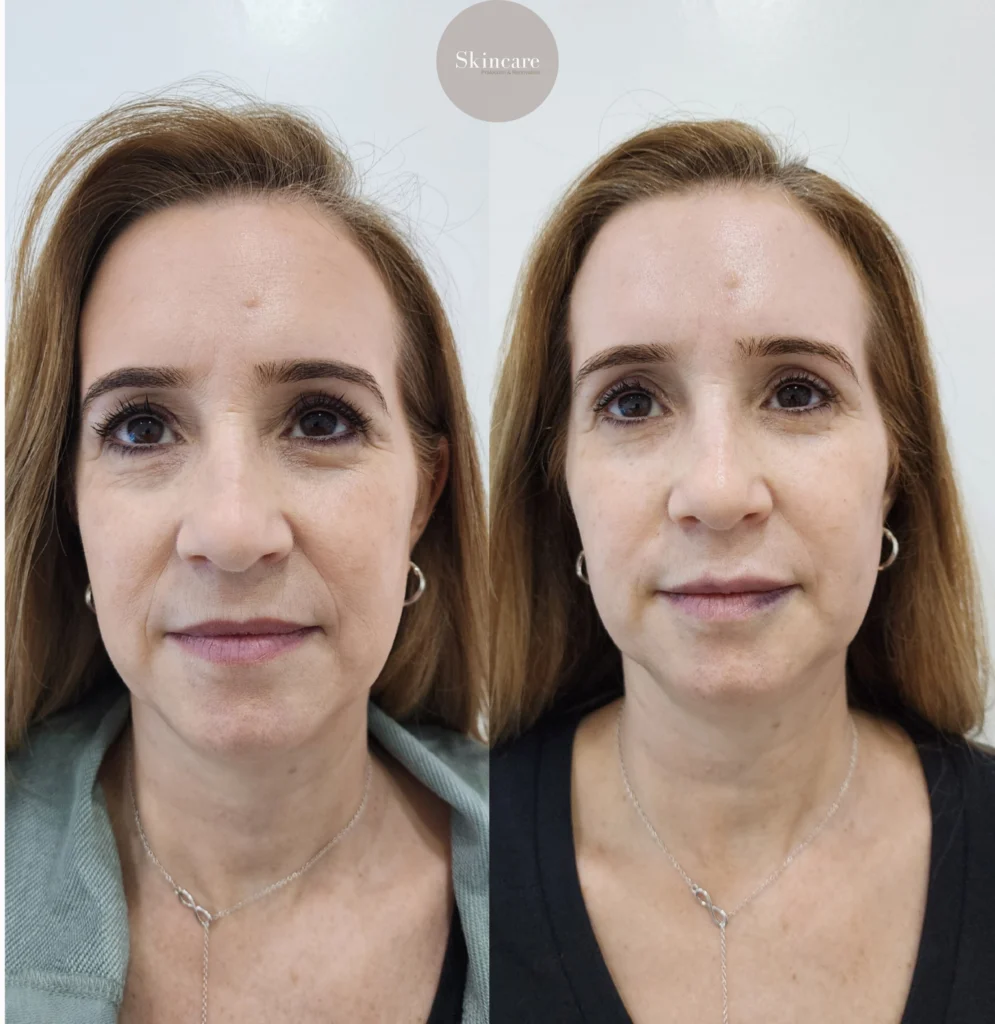 resultado full face en medellin