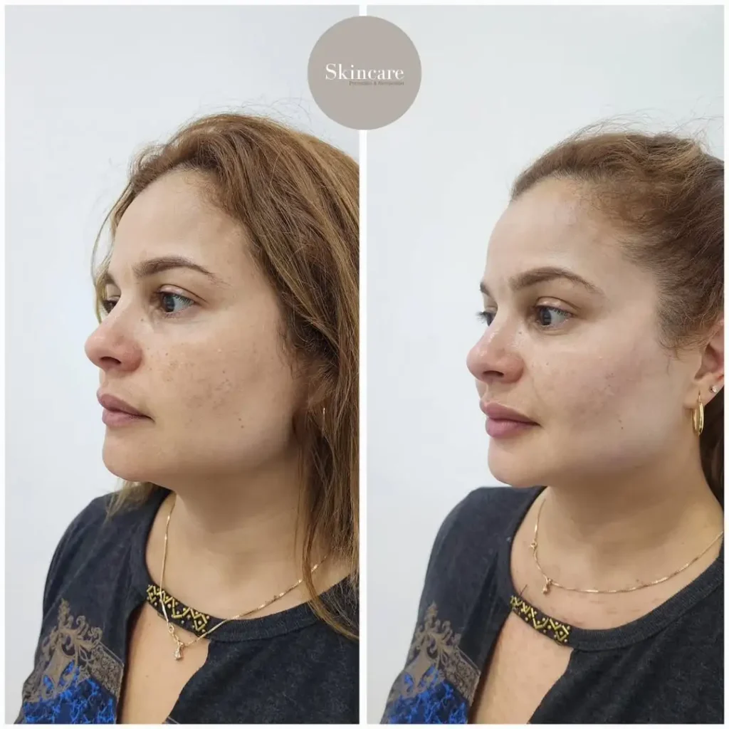 FULL-FACE-.Con-el-tiempo-la-piel-va-perdiendo-elasticidad_-Hidrataciòn-y-volumen