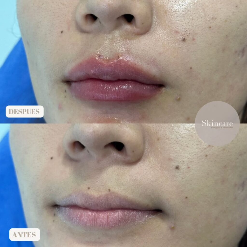 LABIOS HIDRATADOS Definición y un poco de aumento con ácido hialurónico.Duración- 1 año y medio Dolor - Medio- se realiza con anestesia#labios#medicoestetico#esteticaenvigado