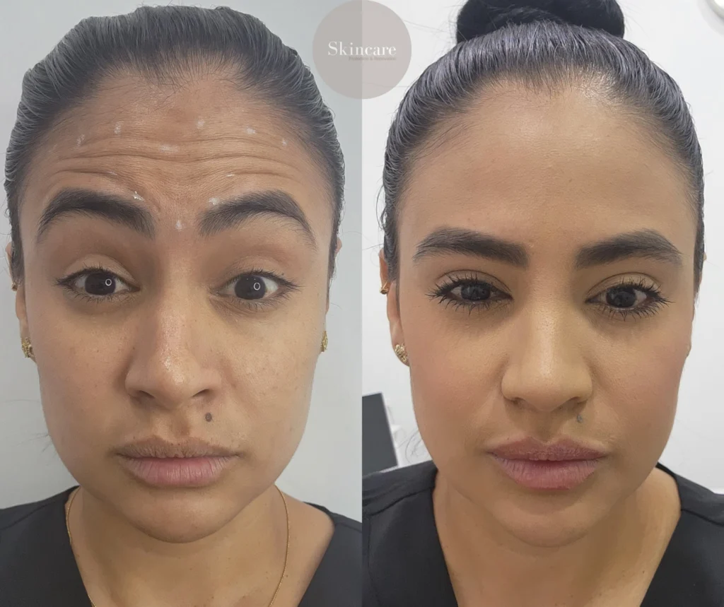 ANTES Y DESPUES BOTOX