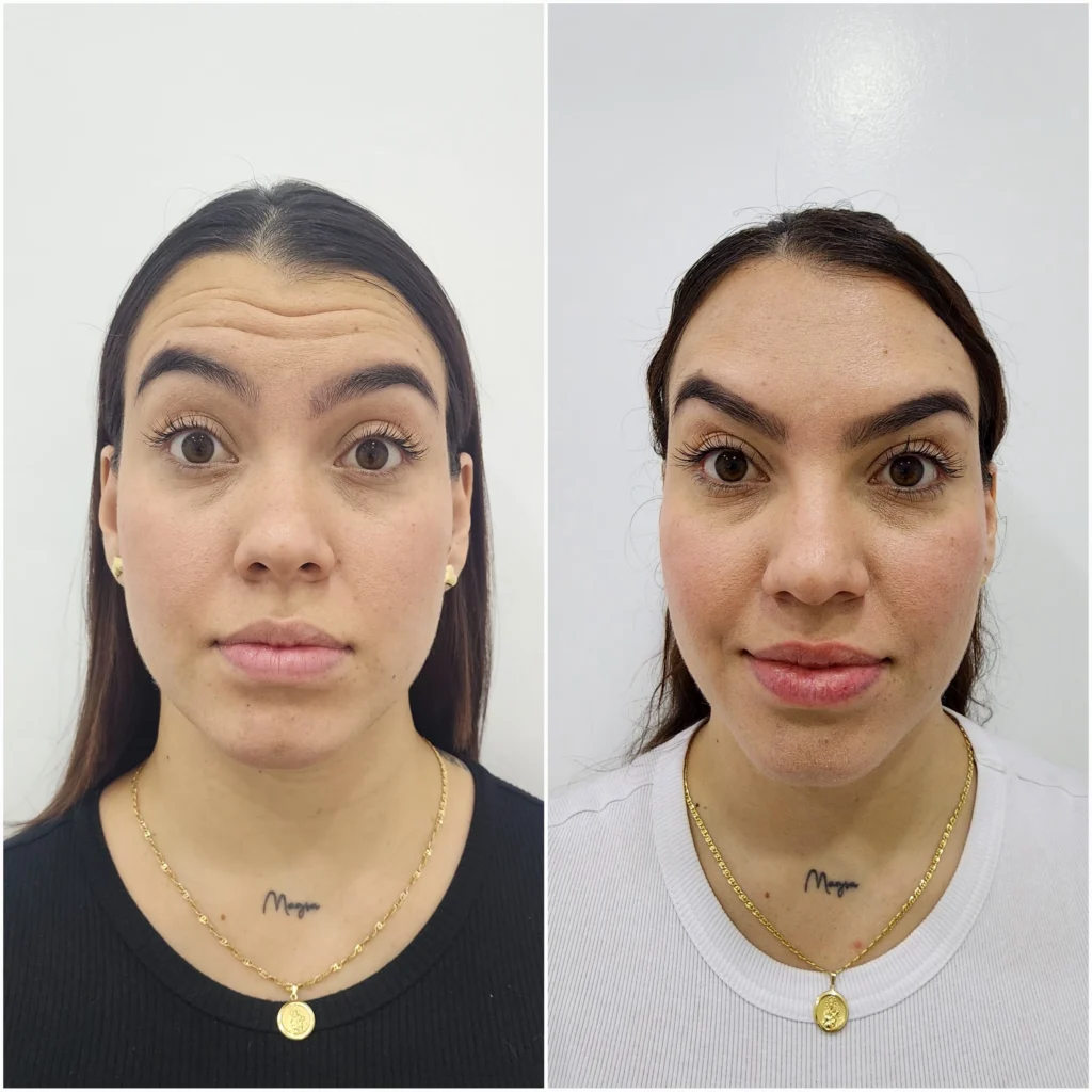 BOTOX EN MEDELLIN RESULTADO