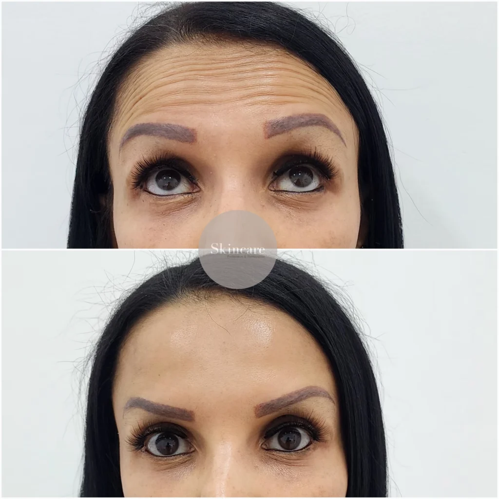 RESULTADO BOTOX EN MEDELLIN