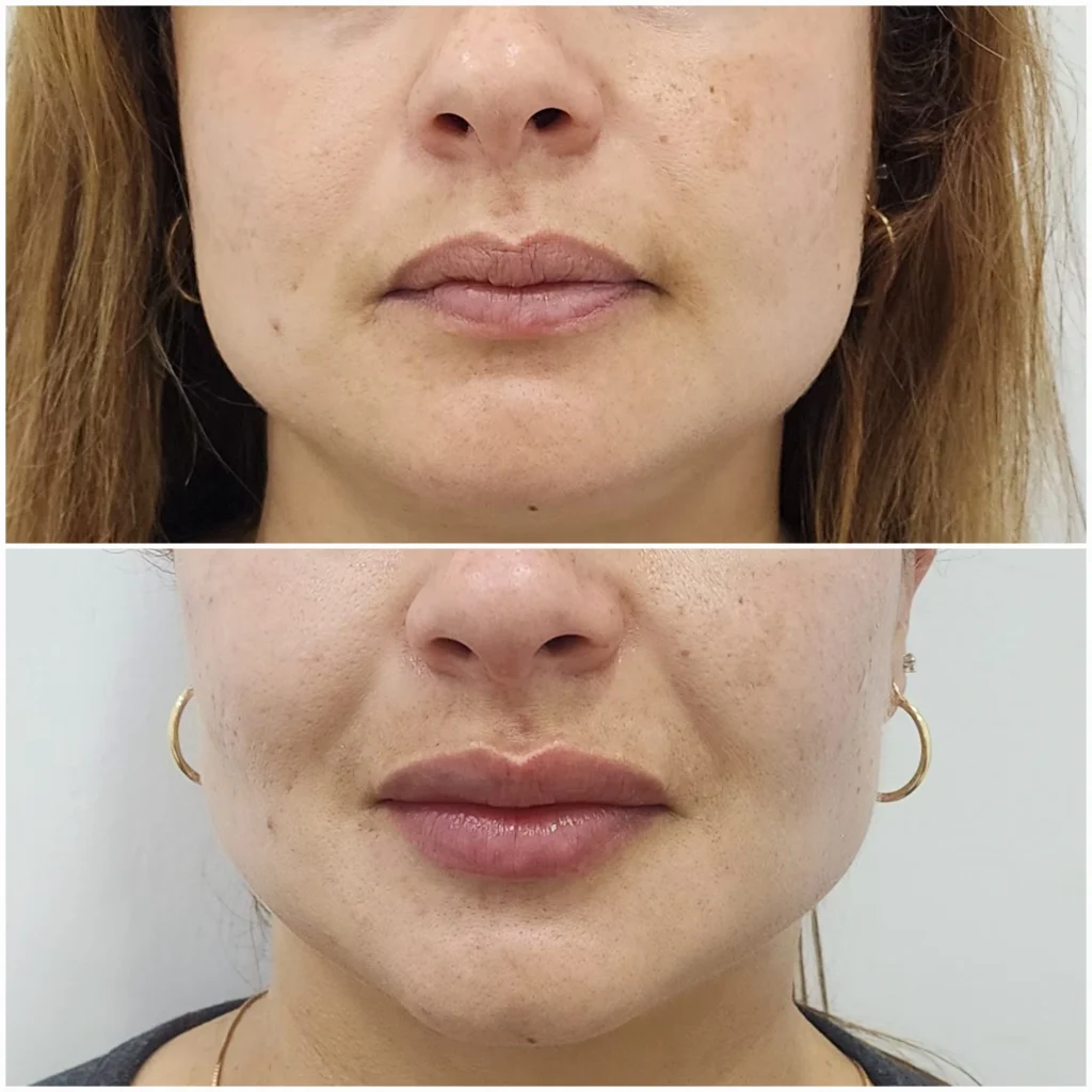 antes y despues aumento de labios