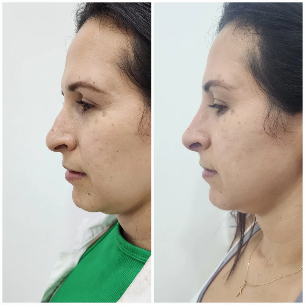 antes y despues rinomodelacion medellin