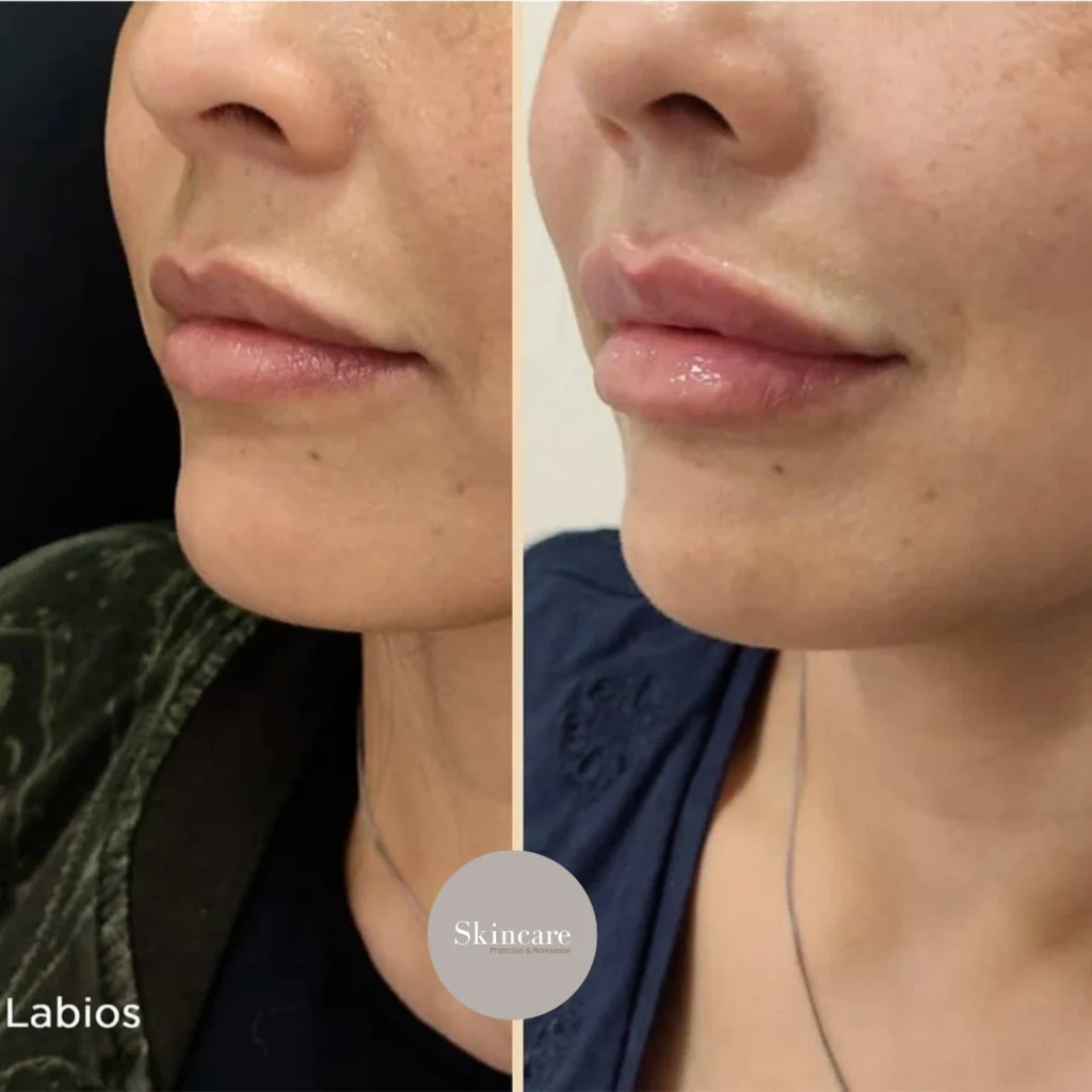 aumento de labios con acido hialuronico