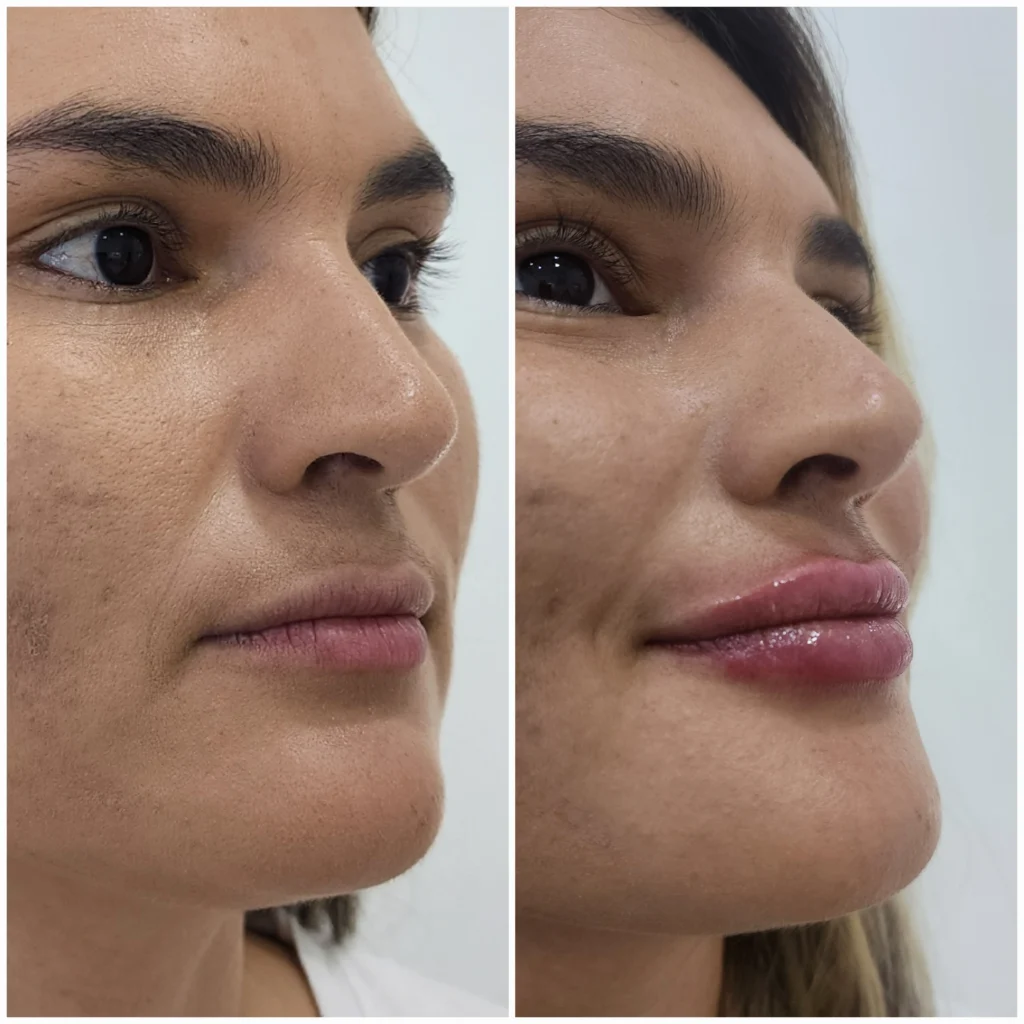 hidratacion de labios antes y despues