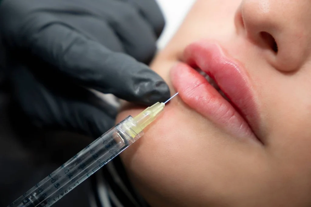 labios con acido hialuronico en medellin