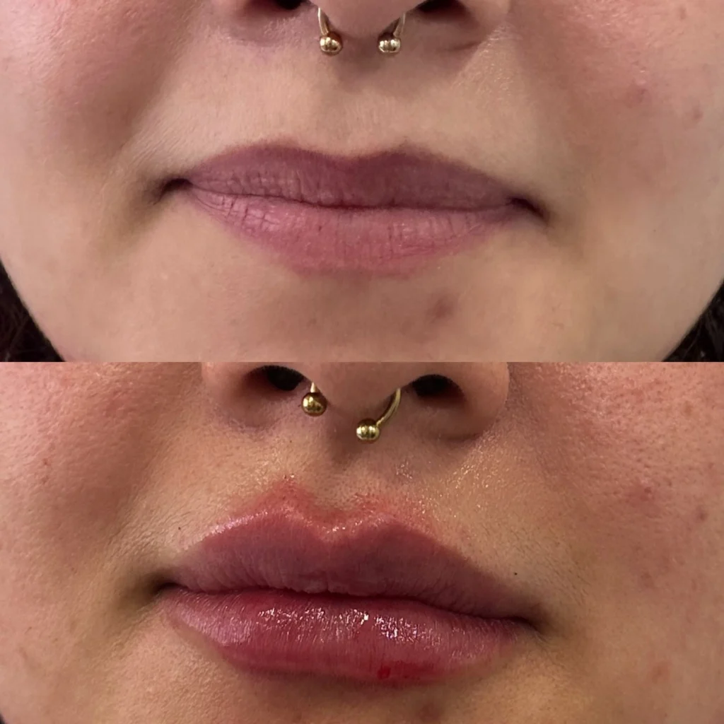 resultado aumento de labios en medellin
