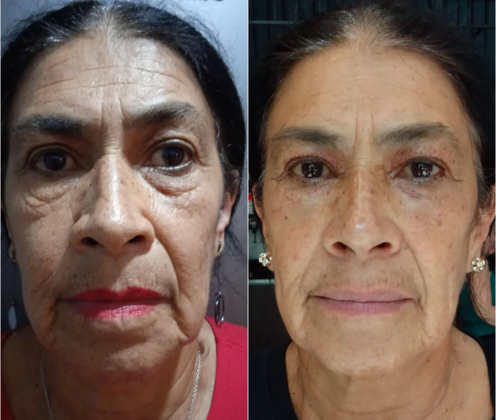 antes y despues de ojeras