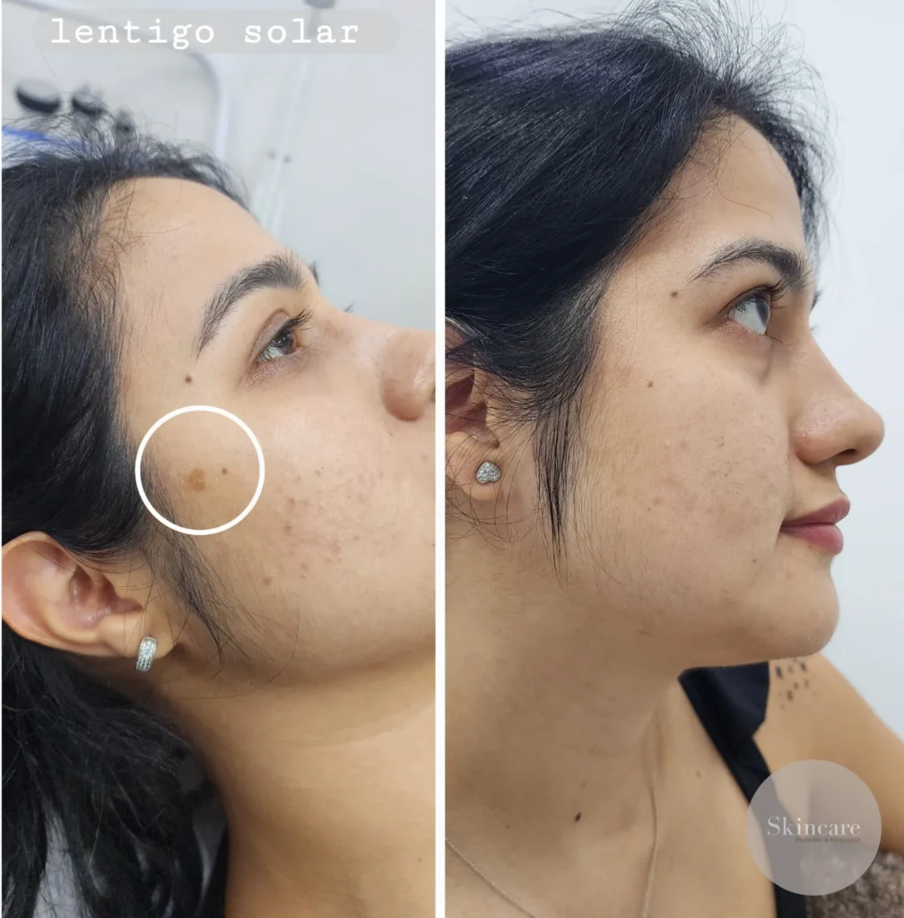 antes y despues tratamiento para manchas en medellin