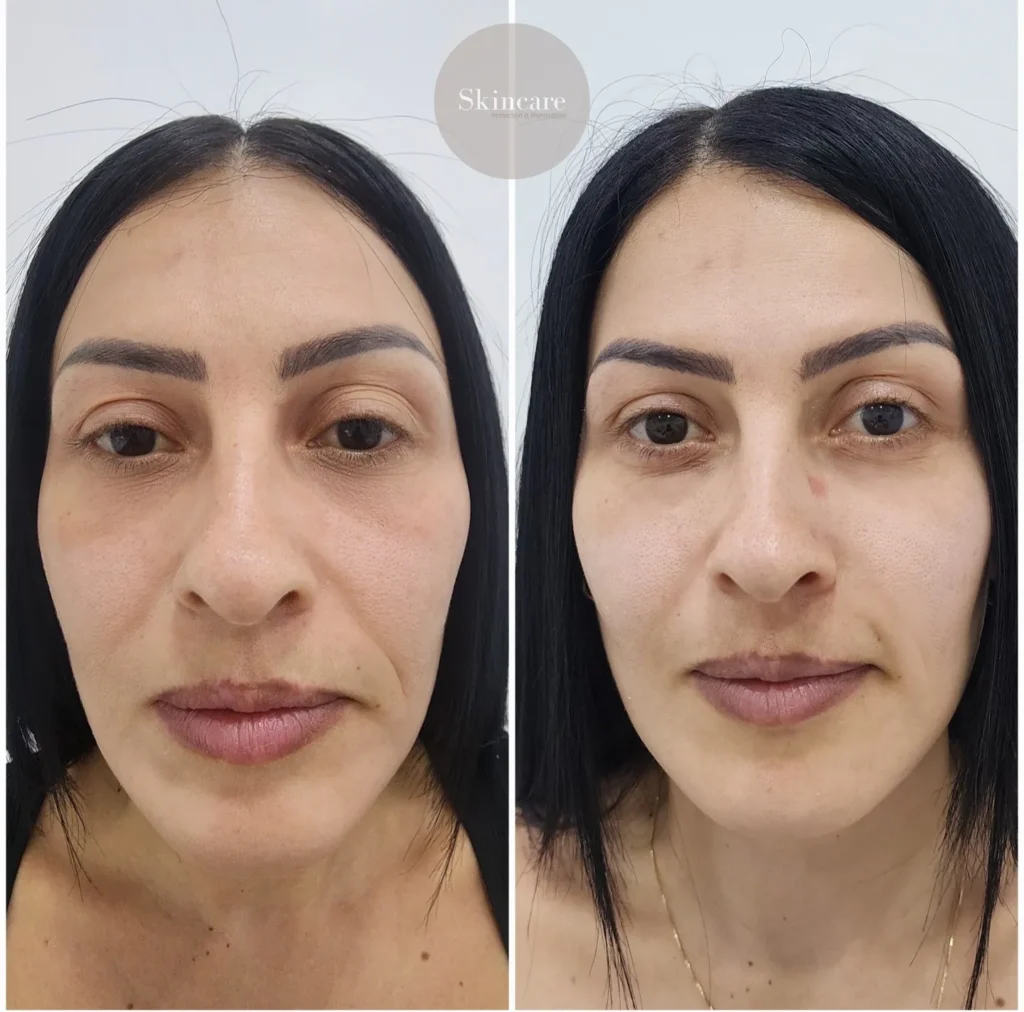 ayd acido hialuronico en ojeras