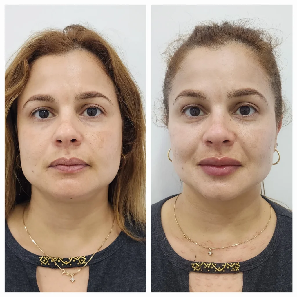 ayd bioestimuladores de colageno