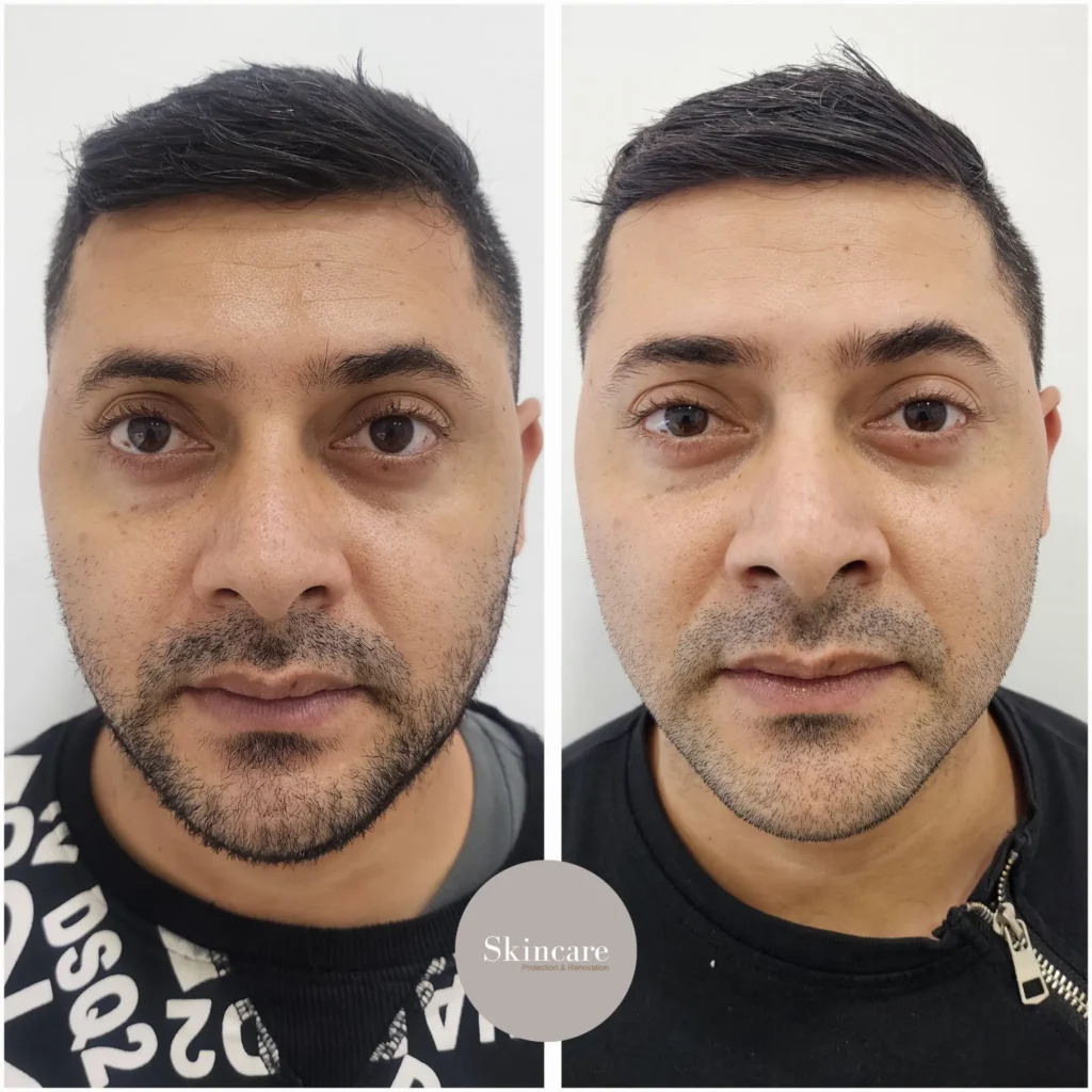 como se ve el tratamiento para ojeras