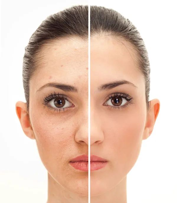 eliminar las manchas del rostro
