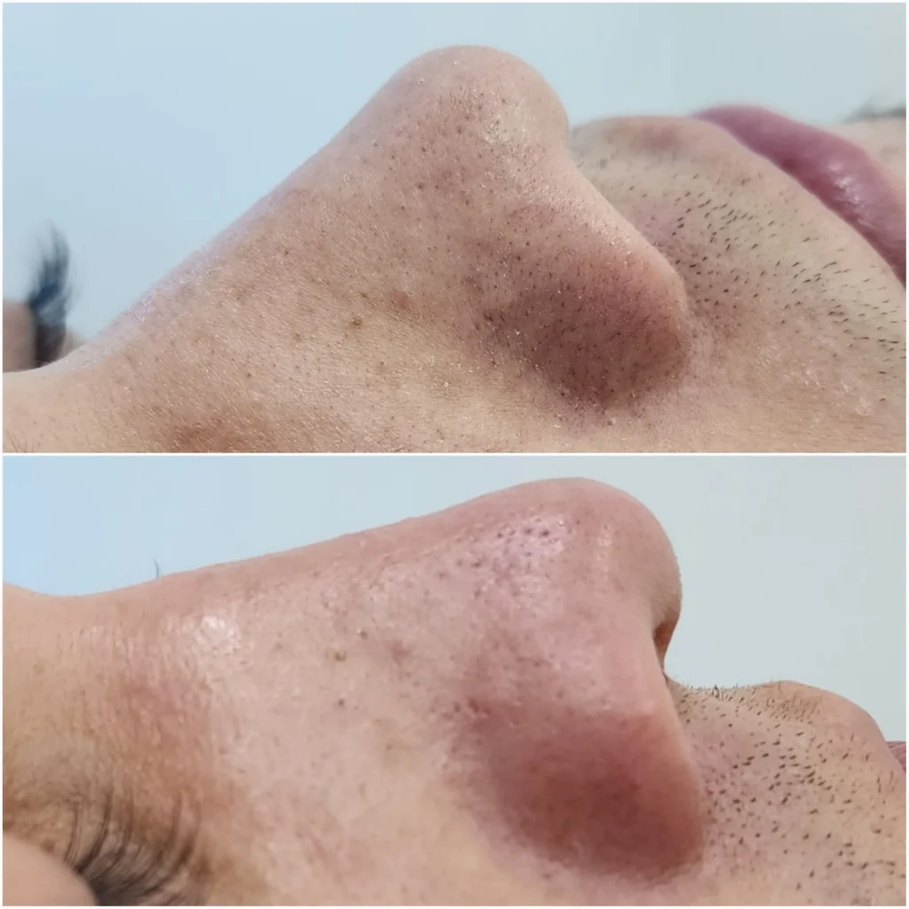 limpieza facial en medellin