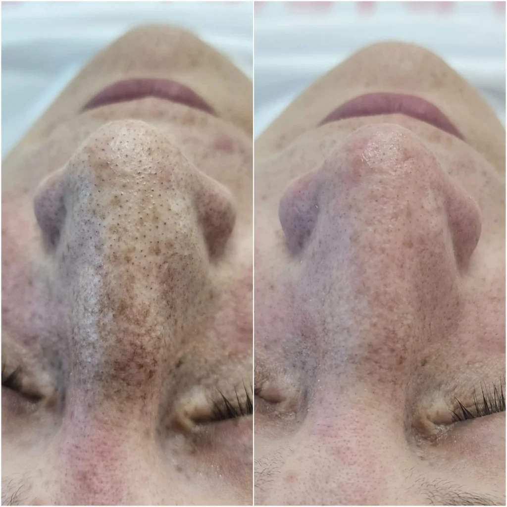 limpieza facial profunda en medellin
