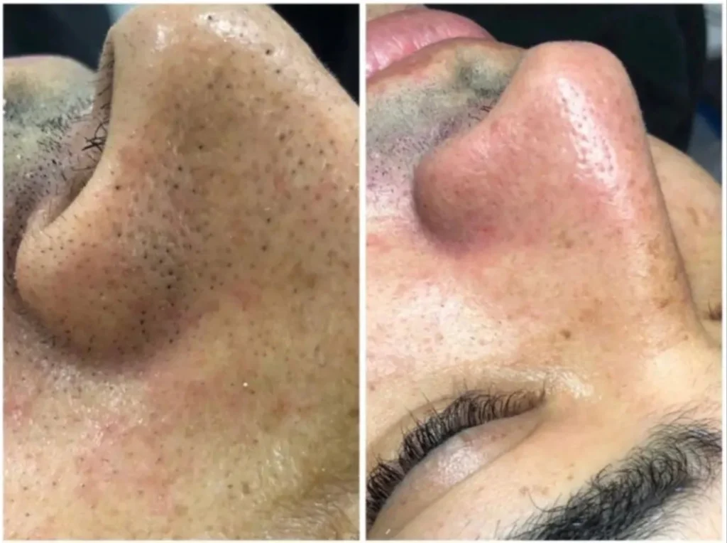 limpieza facial profunda envigado