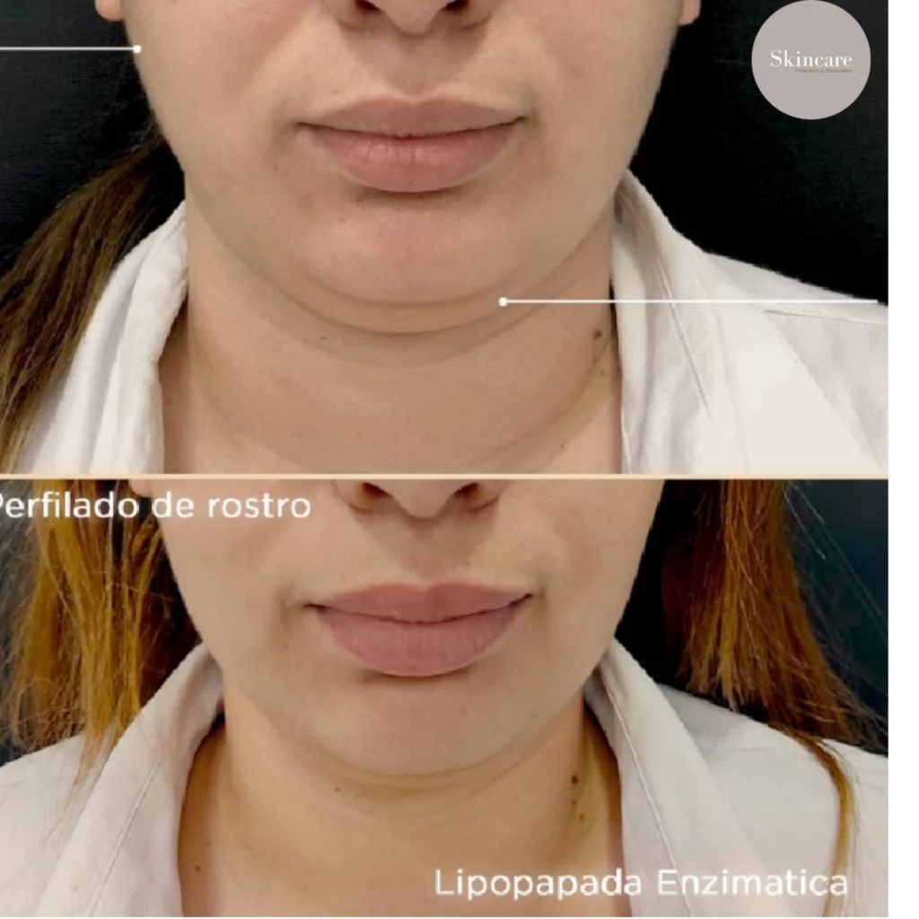 lipopapada sin cirugia en medellin