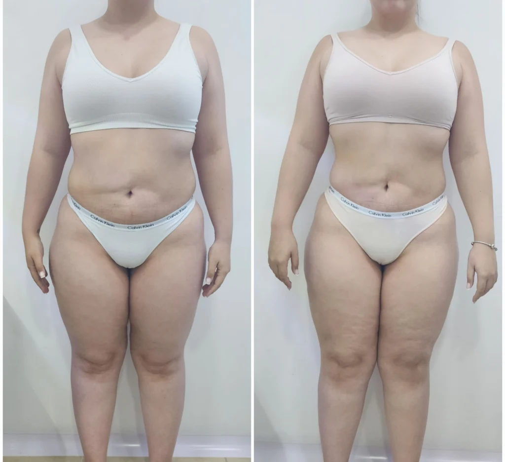 perder peso sin cirugia