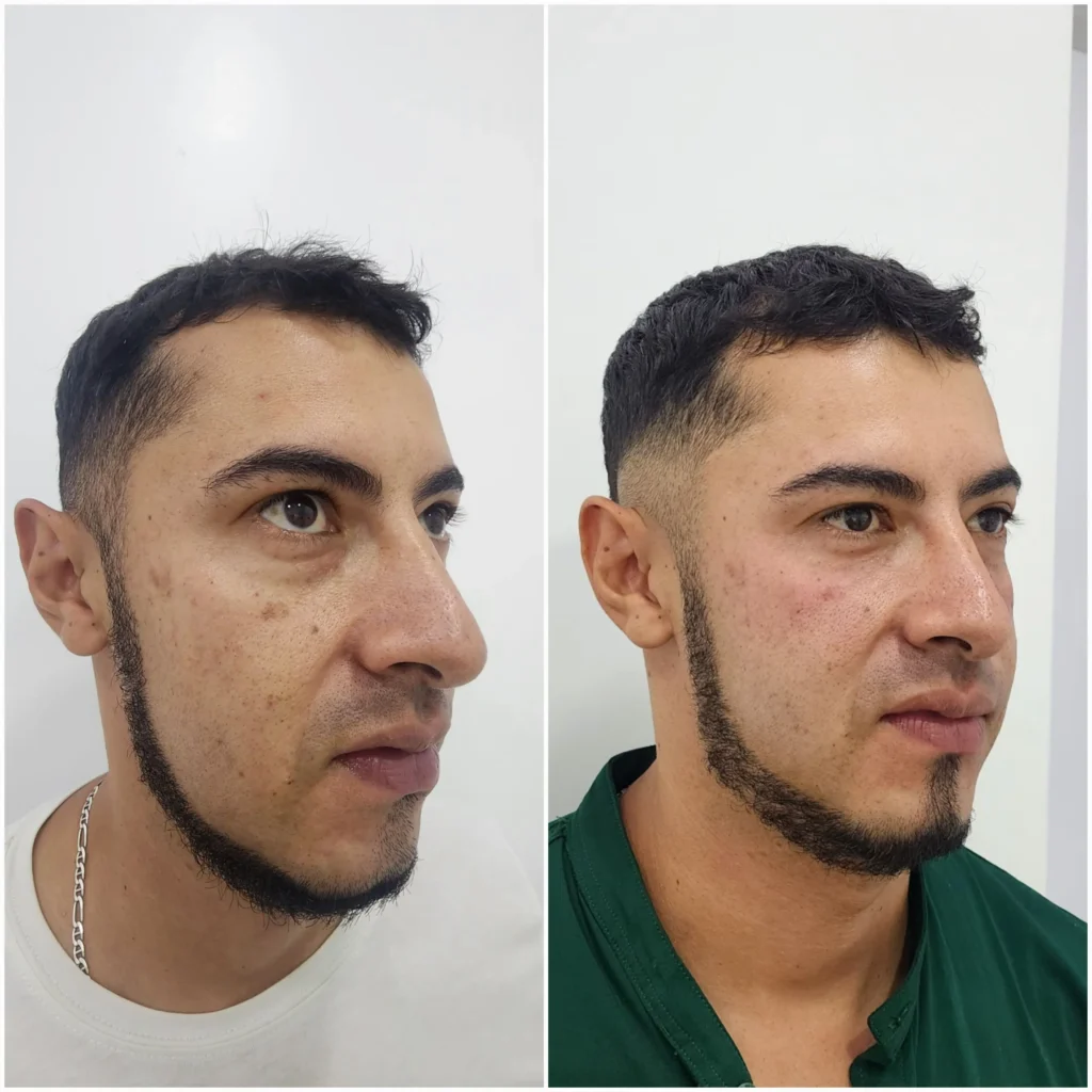resultado de correccion de ojeras