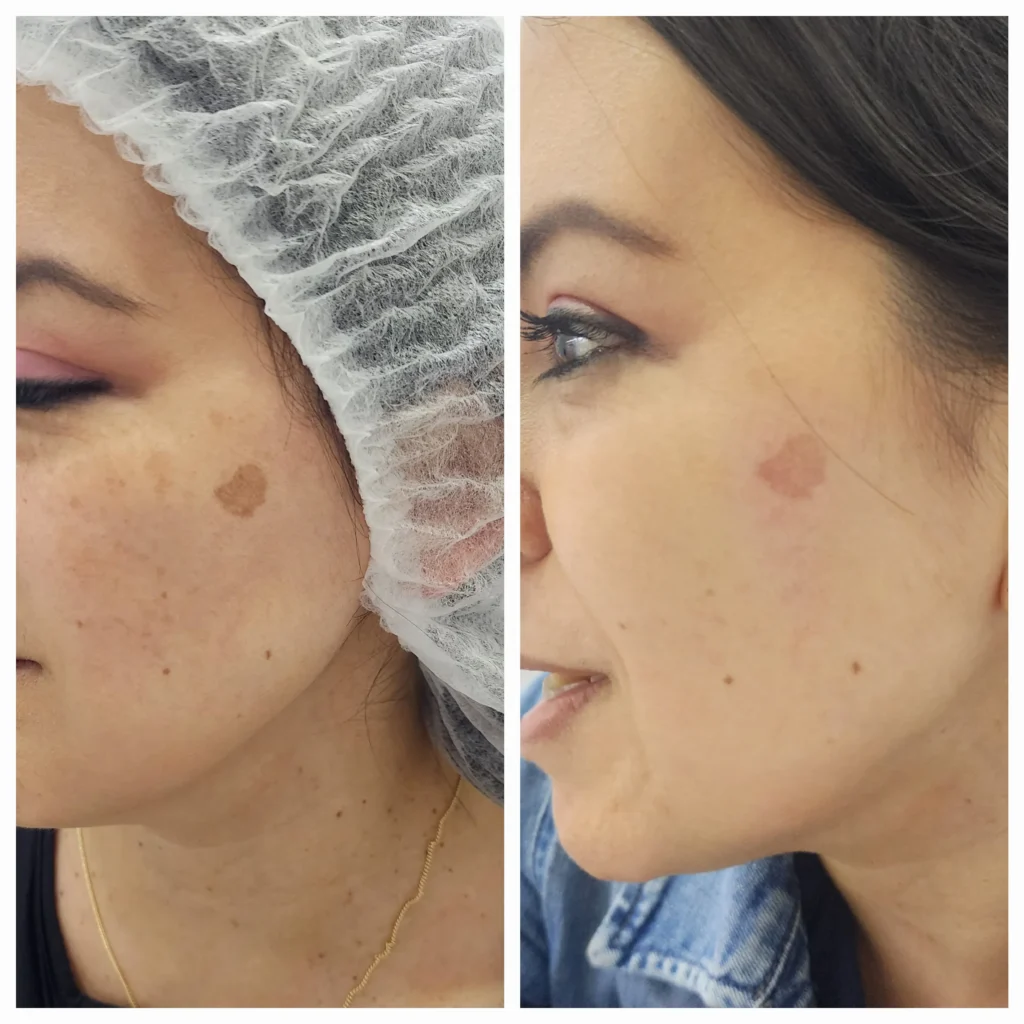 resultado de tratamiento antimanchas