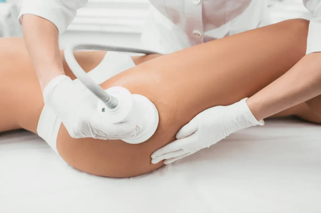 tratamiento para las celulitis